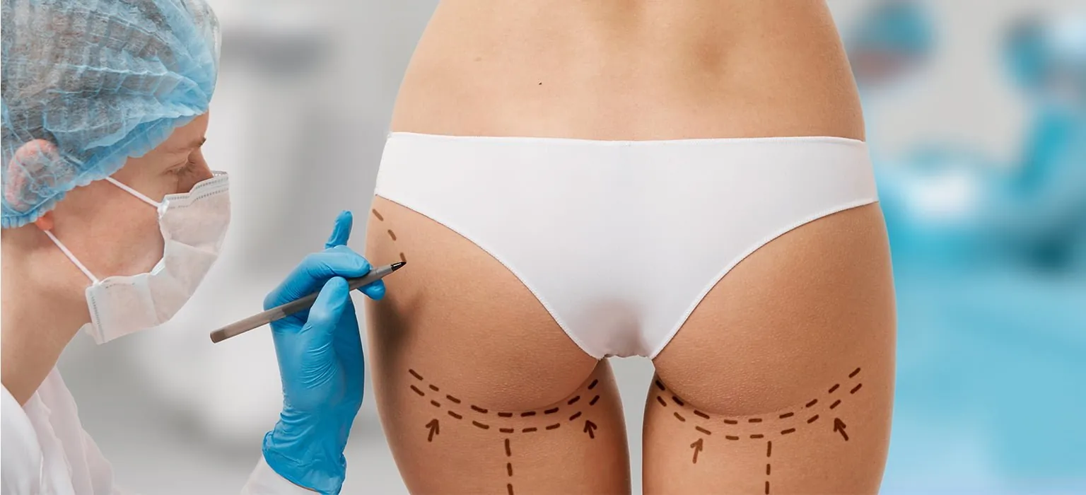 A surgeon marking the hips and thighs before a body lift