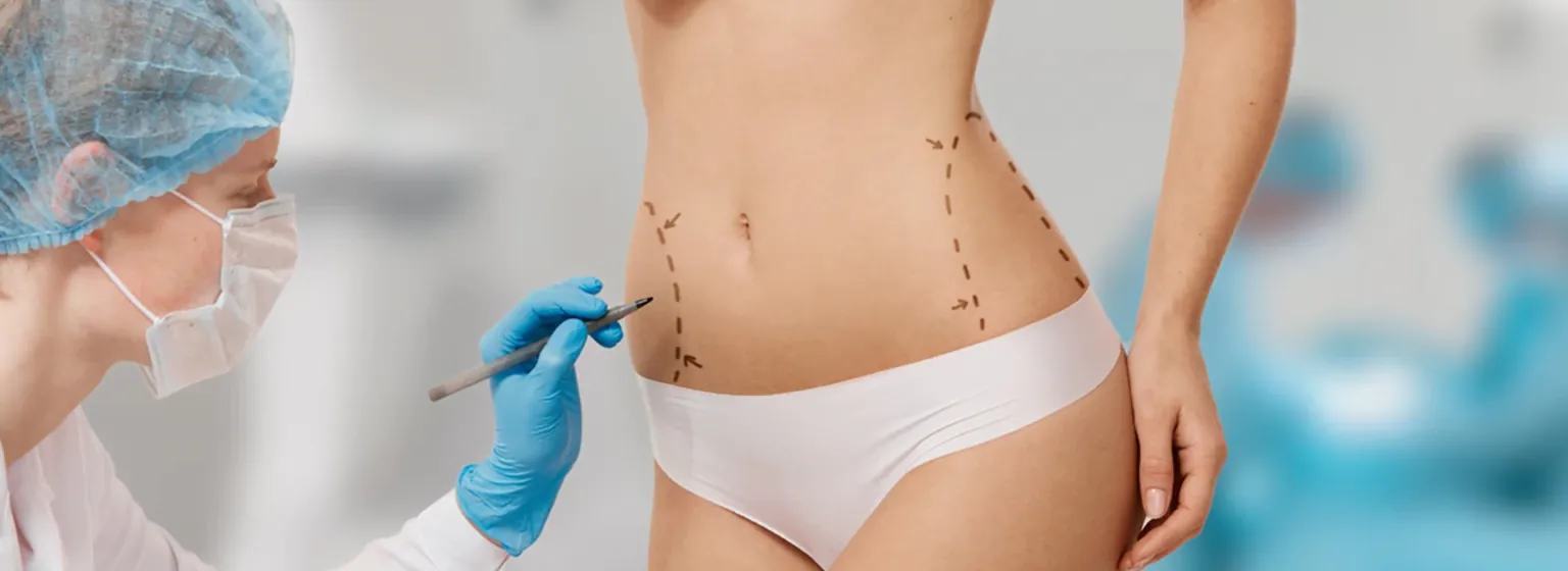 A surgeon marking the abdomen before liposuction
