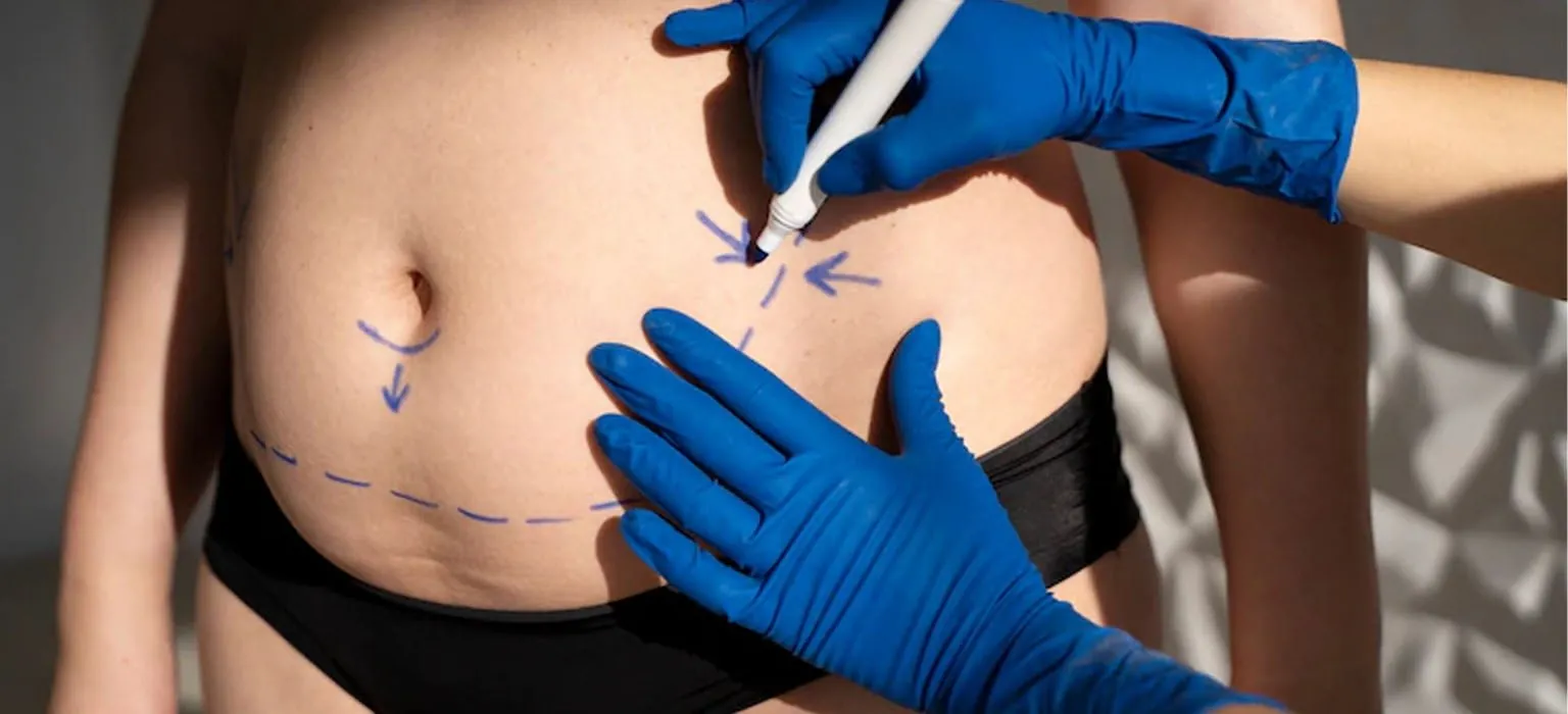 A surgeon marking the abdomen before liposuction