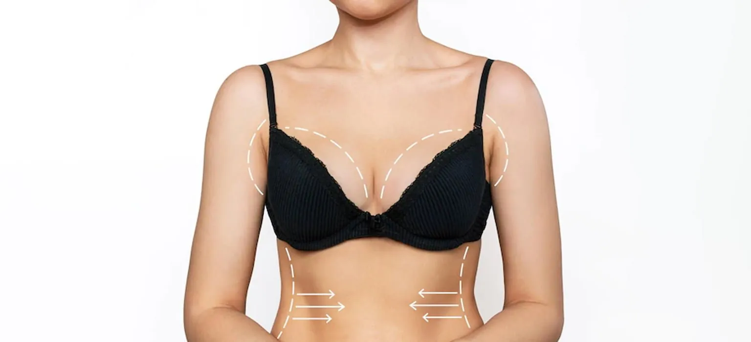 A woman's chest marked for breast surgery