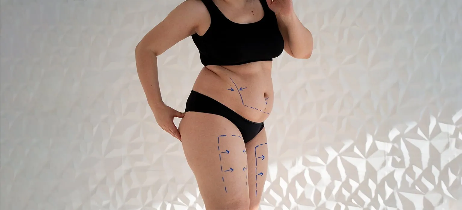 A woman's abdomen marked before a tummy tuck