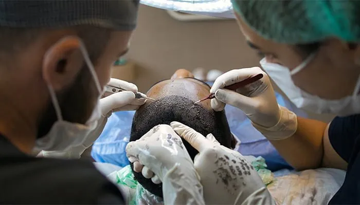 A hair transplant in progress, with grafts being placed in the scalp