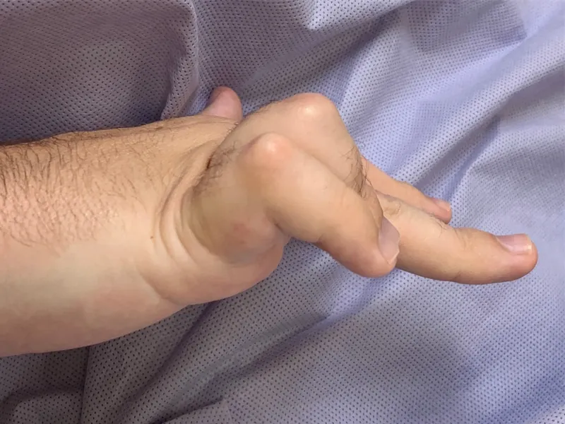 A little finger that cannot fully straighten