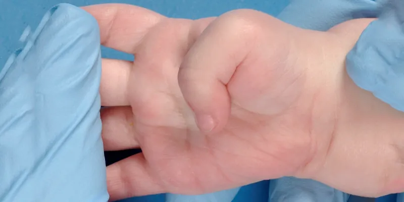 A thumb bent across the palm