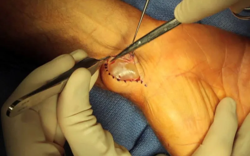 A lump on the back of the wrist being removed