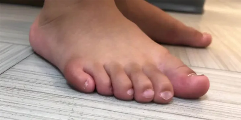 A foot with an extra toe