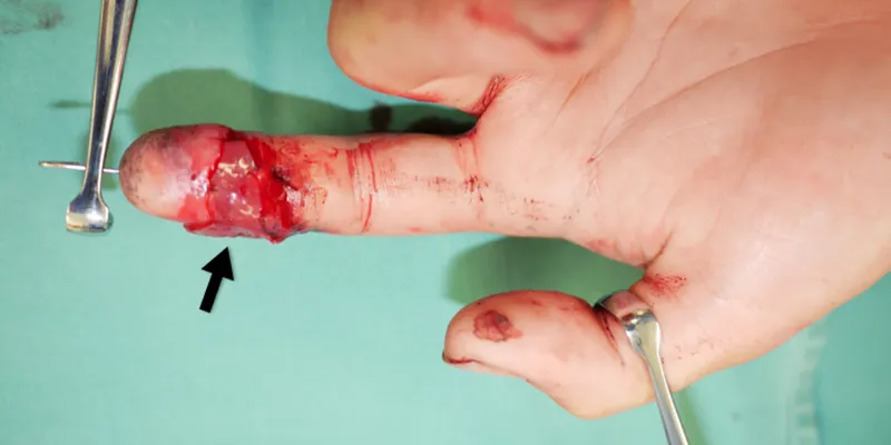 A finger being reattached during surgery