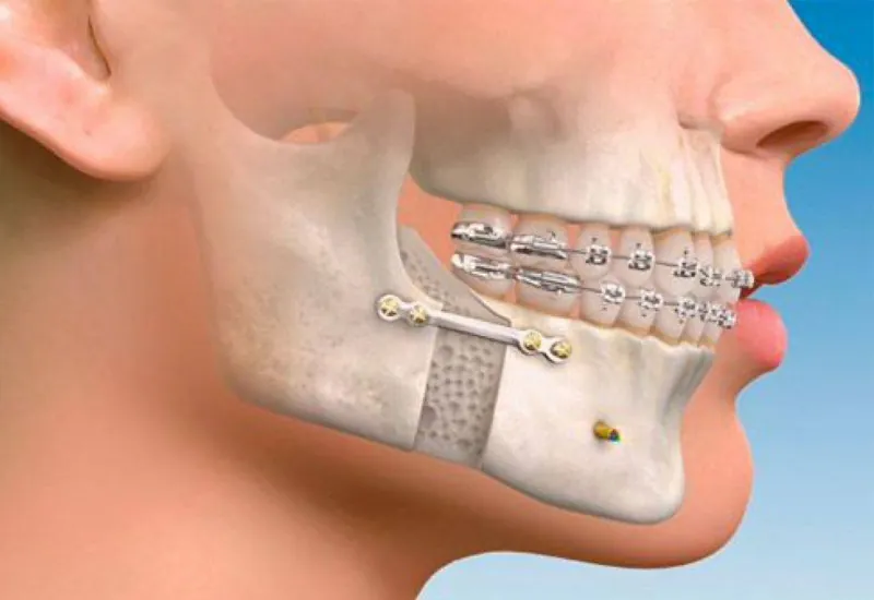 Drawing of the jaws and teeth with braces