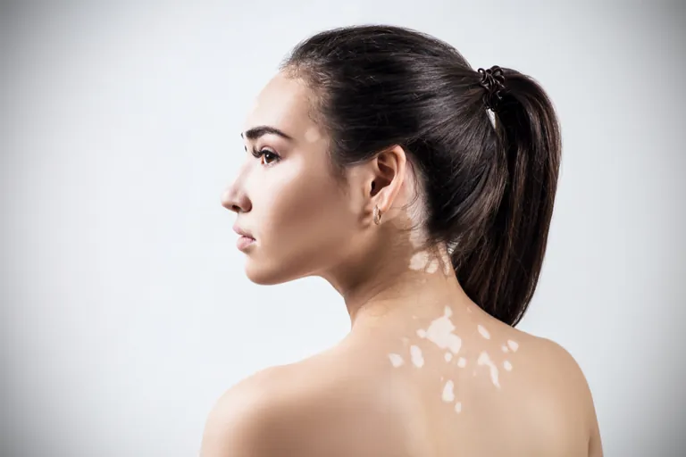 Vitiligo patches on a woman's back and shoulder